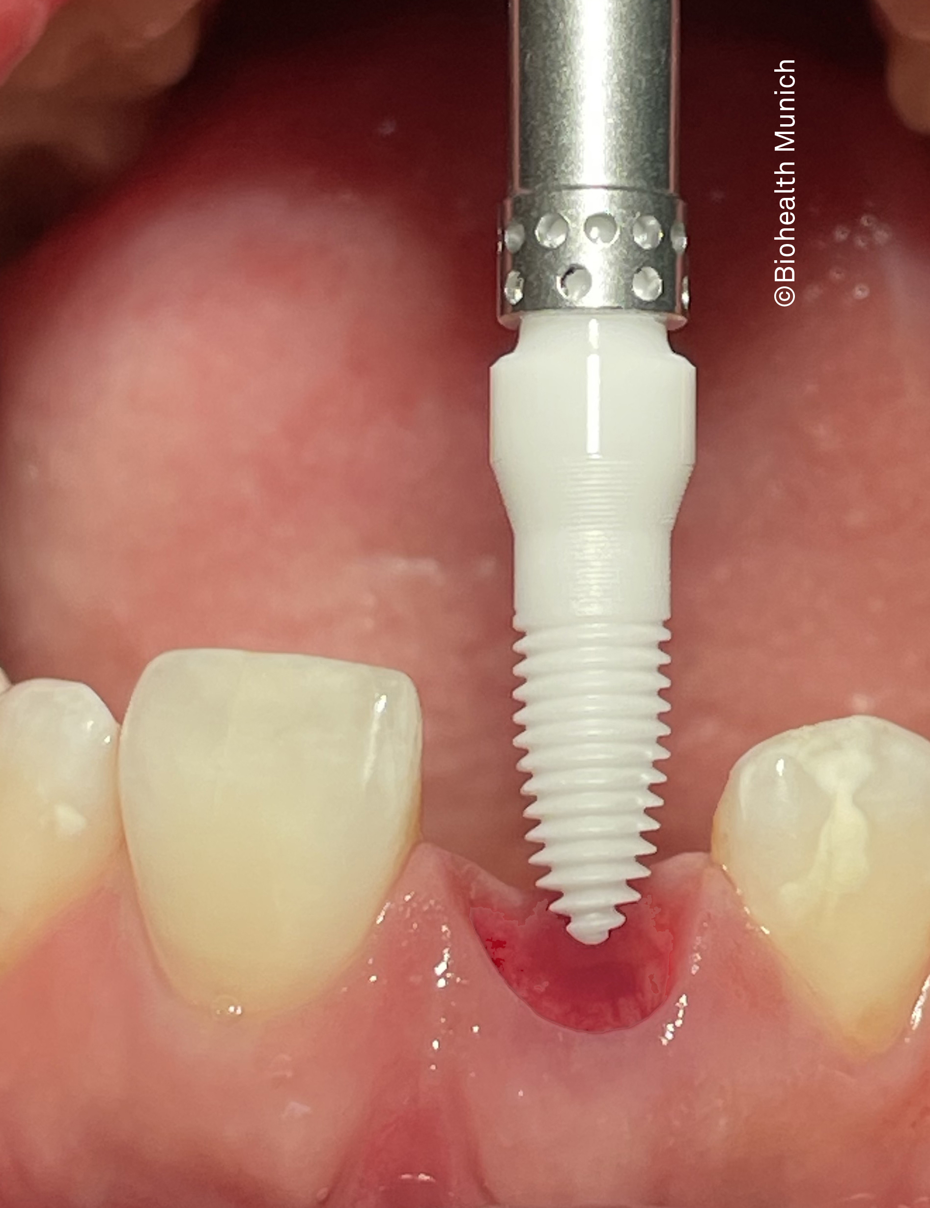 Ceramic implants from Biohealth in Munich
